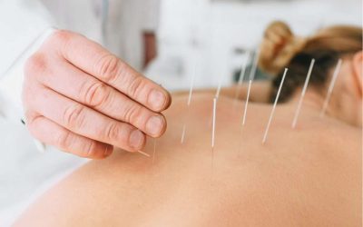 Dry-Needling-1024x722-1