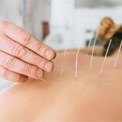 Dry-Needling-1024x722-1