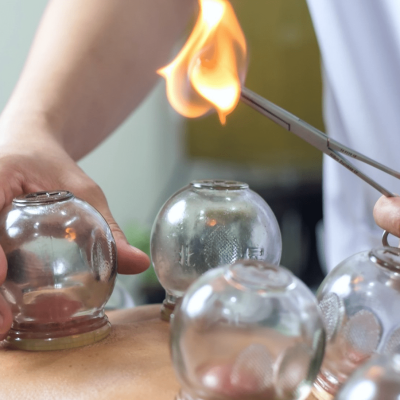 fire-cupping-12-8e5c50b6